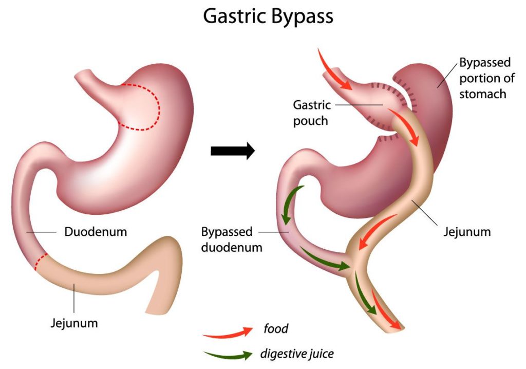 Gastric Sleeve Stomach