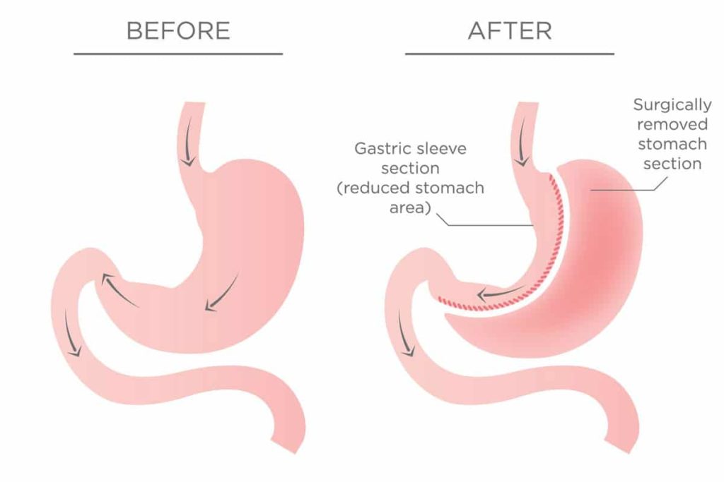 stomach sleeve operation