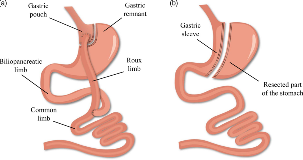 stomach sleeve operation